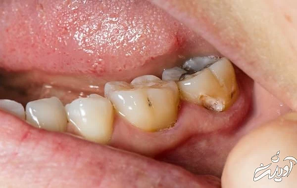 باکتری پوسیدگی دندان دلیل پوسیدگی دندان